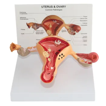 Модель поражения матки, патология яичников, анатомия женских половых органов